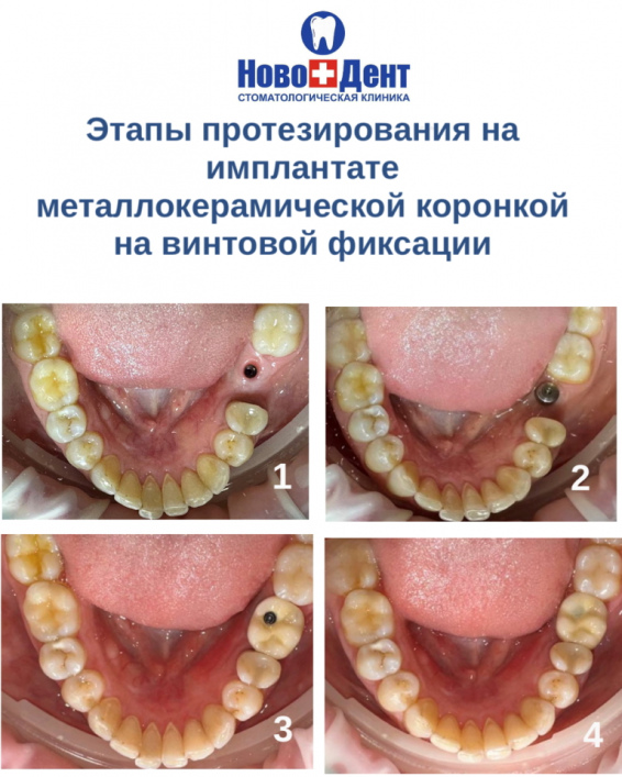 Имплантация зубов: фото 3