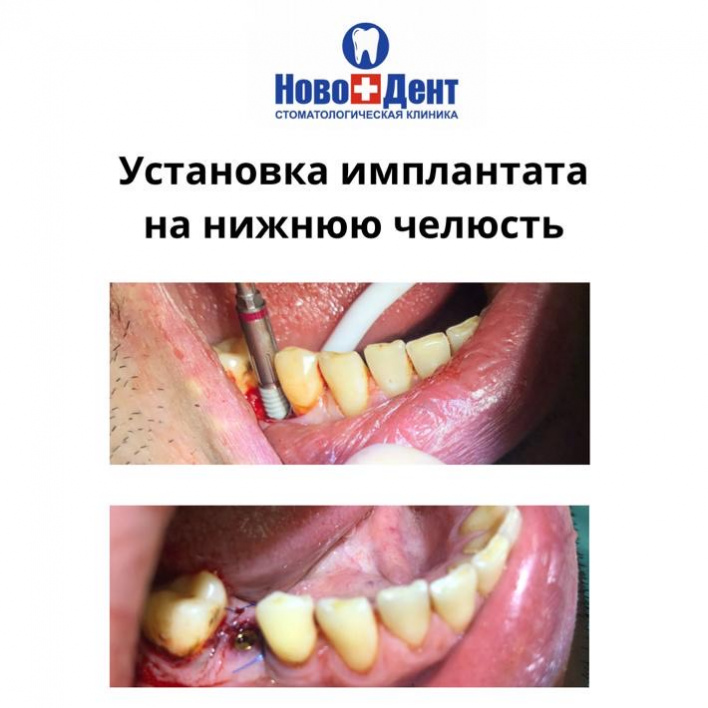 Имплантация зубов: фото 4