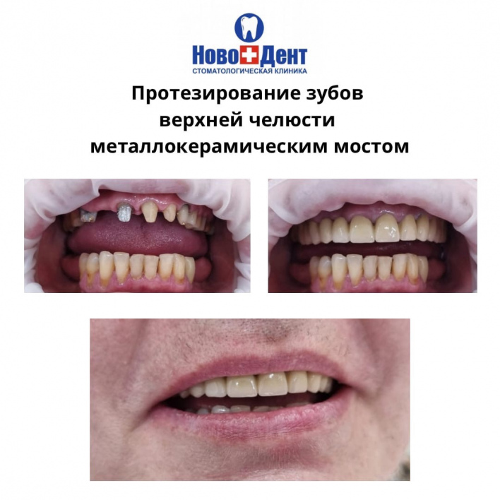 Мостовидные протезы: фото 3