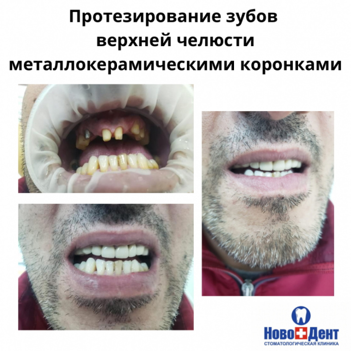 Мостовидные протезы: фото 4