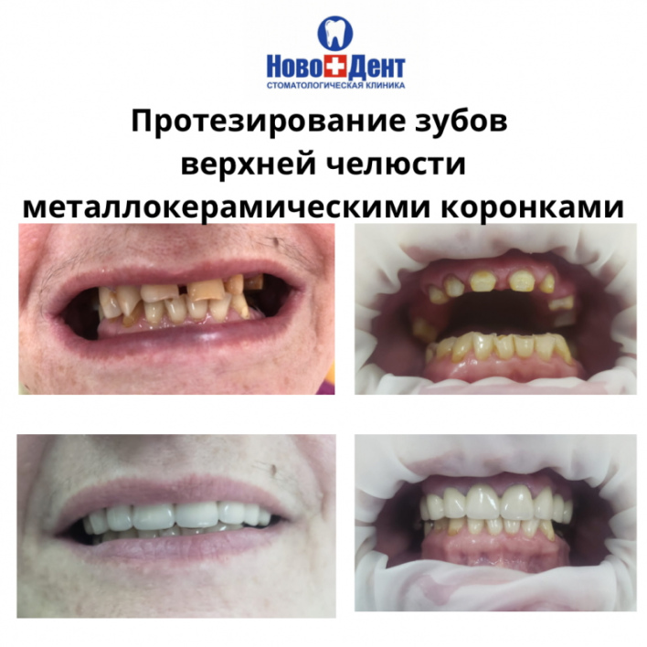 Мостовидные протезы: фото 5