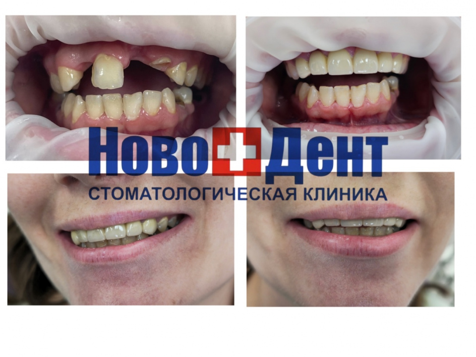 Зубные коронки: фото 1