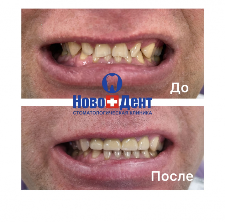Зубные коронки: фото 2