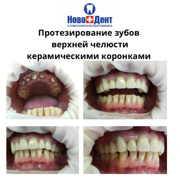 Зубные коронки: фото 5