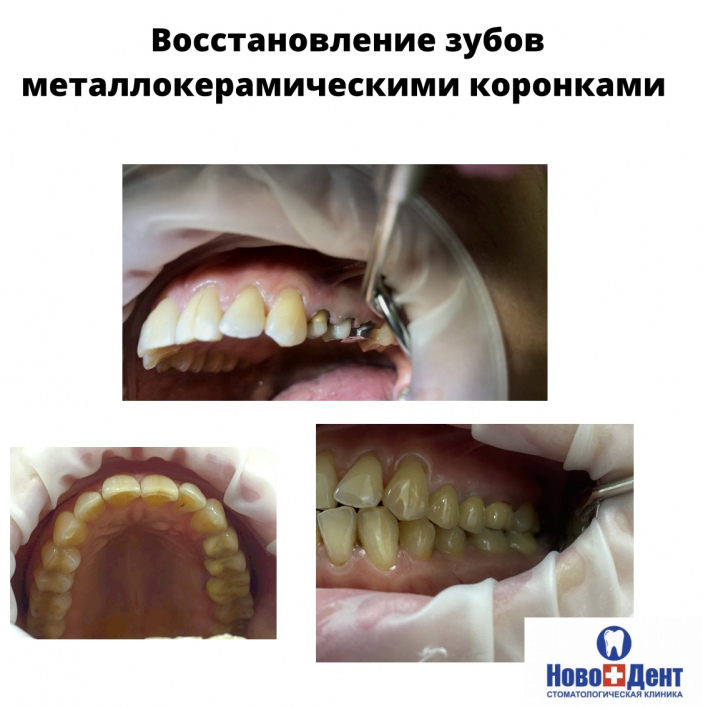 Зубные коронки: фото 6