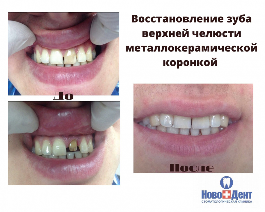 Зубные коронки: фото 7
