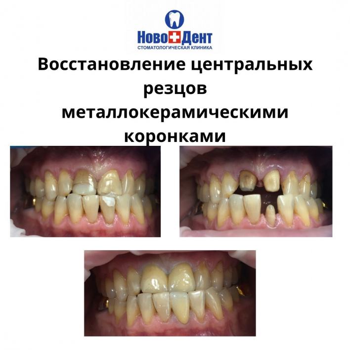Зубные коронки: фото 8