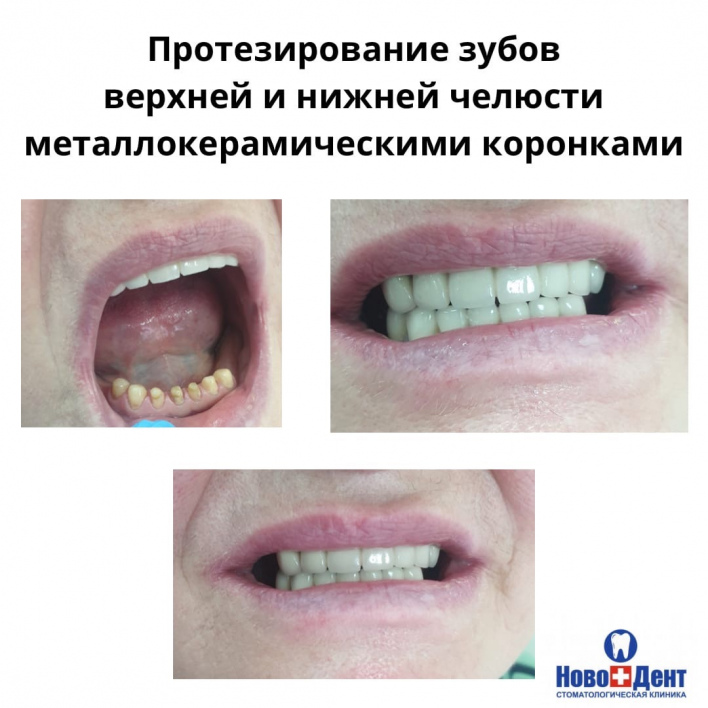 Зубные коронки: фото 9