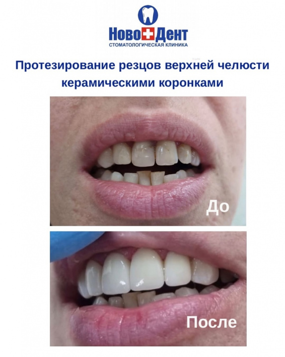 Зубные коронки: фото 11